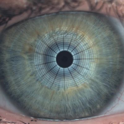 Czy zespół suchego oka przebiega inaczej u kobiet niż u mężczyzn?